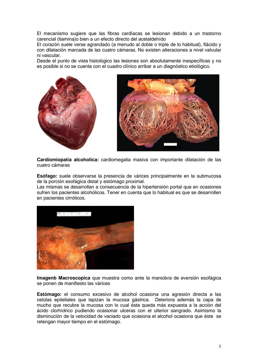# ALCOHOLISMO
Prof. Titular Cátedra de Anatomía y Fisiología Patológicas Dra Ana Lia Nocito
Prof Titular Cátedra de Farmacología y Toxicolo