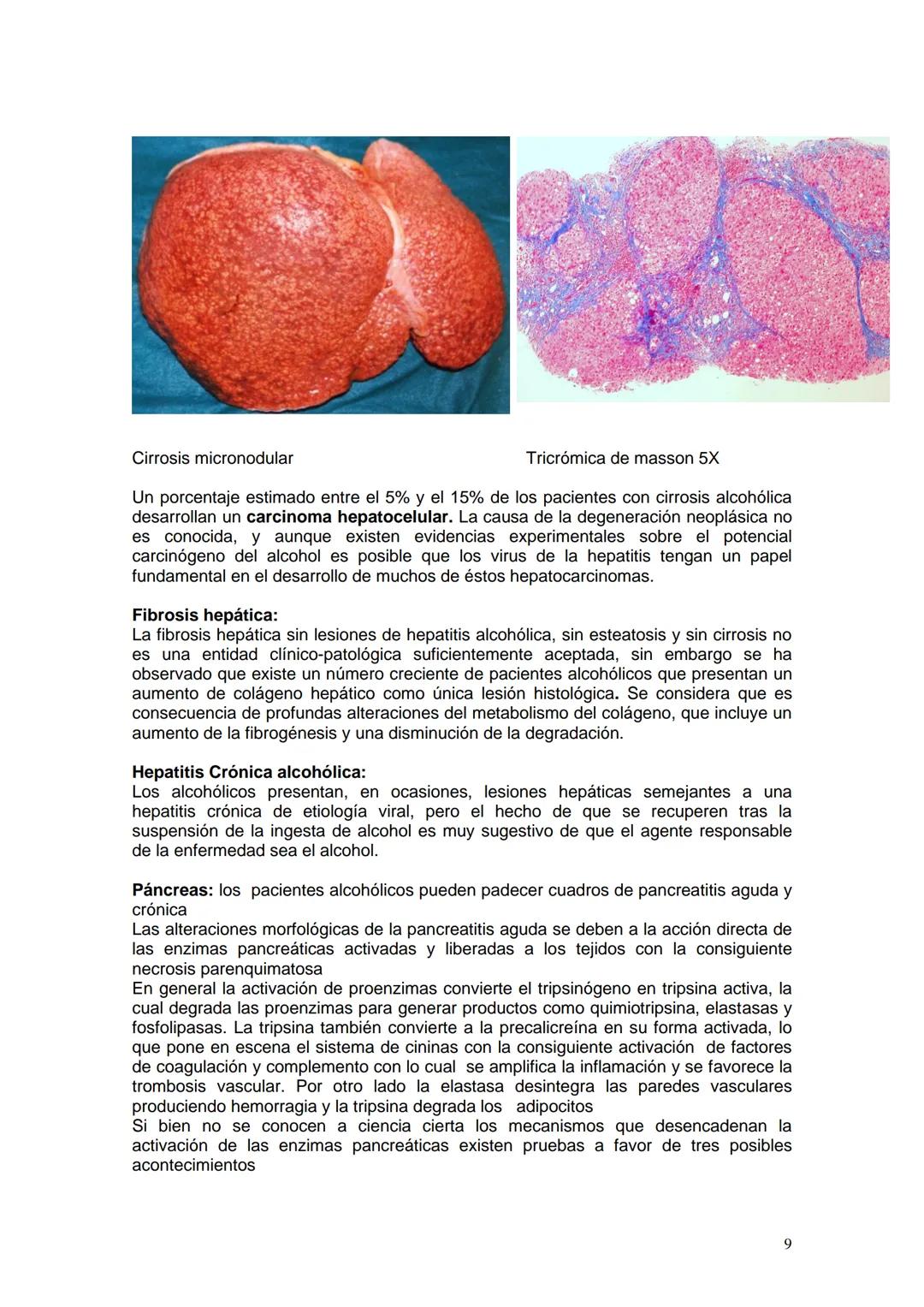 # ALCOHOLISMO
Prof. Titular Cátedra de Anatomía y Fisiología Patológicas Dra Ana Lia Nocito
Prof Titular Cátedra de Farmacología y Toxicolo